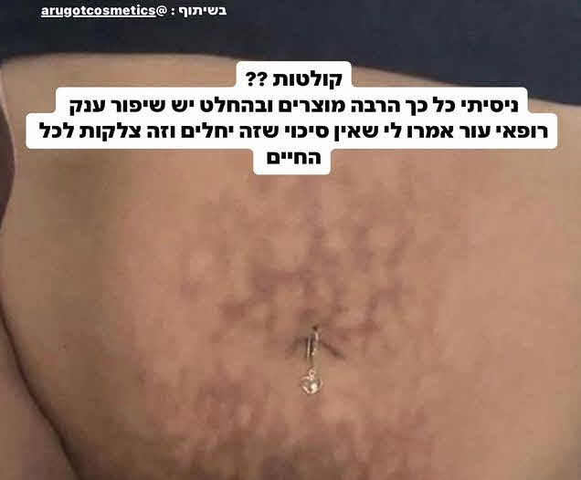 "אתם לא יודעים כמה נזקים אני עושה לעצמי": ספיר בורגיל חושפת באומץ