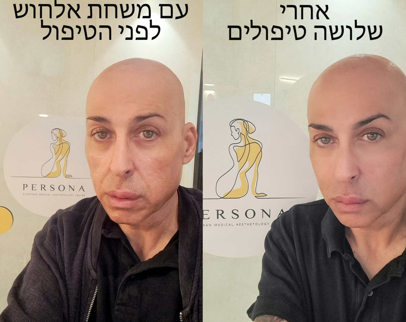 כוכב "האח הגדול" בחשיפה דרמטית: כך השיל 35 קילוגרמים ממשקלו